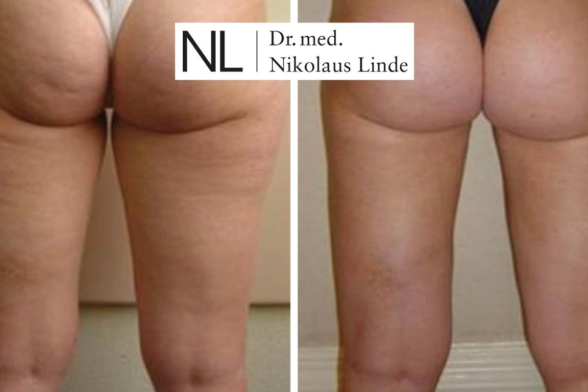 Cellulite Behandlung